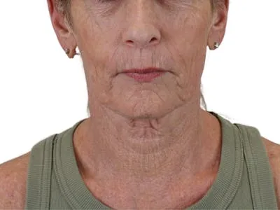 Close-up of a woman's lower face after a lip lift procedure.