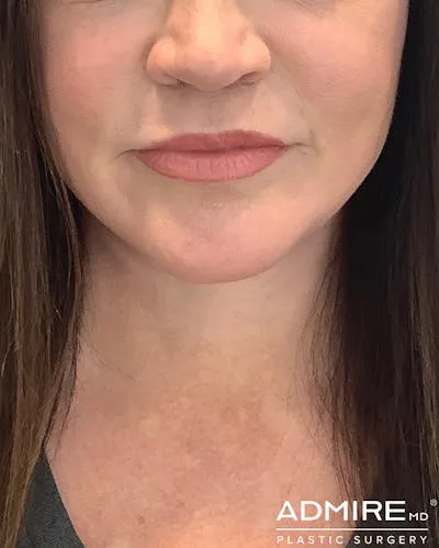 Close-up of a woman's lips after a lip lift procedure.