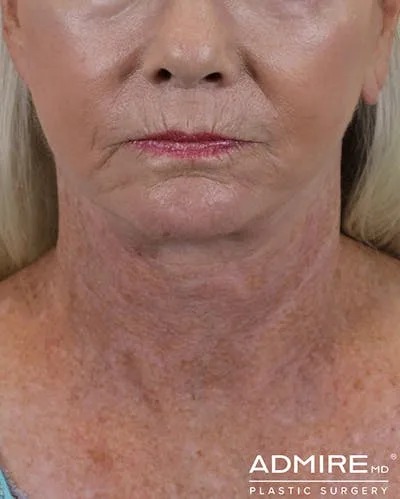 Close-up of a woman's face after a lip lift procedure.
