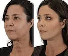 Profile comparison of woman before and after cosmetic treatment.
