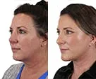 Side profile before-and-after of a facial rejuvenation procedure.