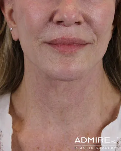 Close-up of a woman's face after a lip lift procedure.
