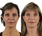 Before-and-after facial rejuvenation results of a woman.
