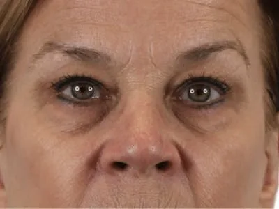 Close-up of a woman's face after blepharoplasty.