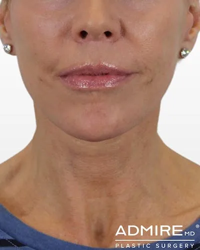 Close-up of a woman's face highlighting her lips.