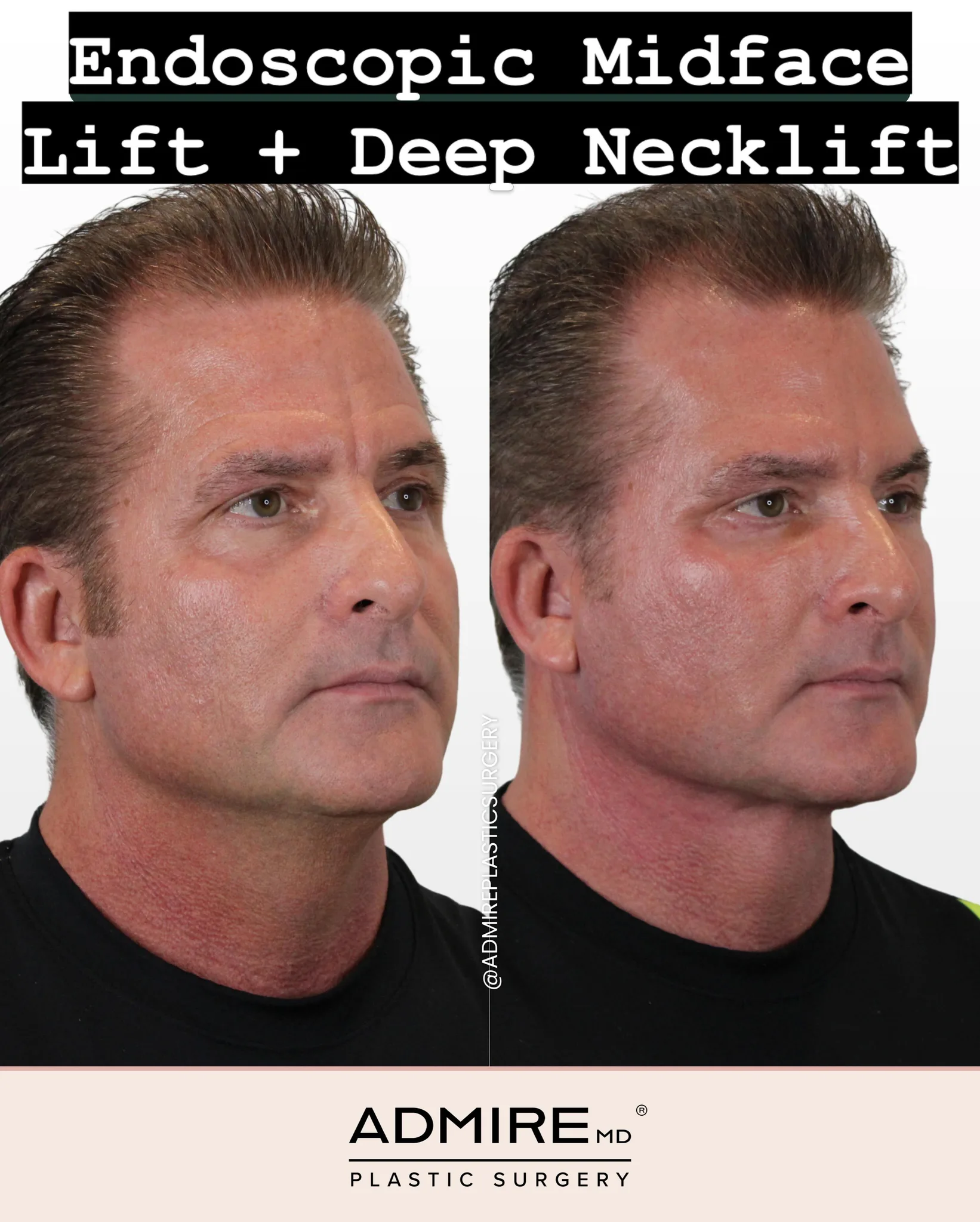 Before and after results of a midface lift and neck lift.