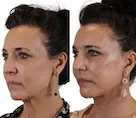 Before and after facelift profile of a woman