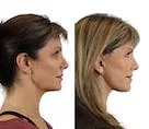 Profile comparison of a woman's facial contours before and after.