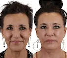 Before and after facelift photo of a woman.