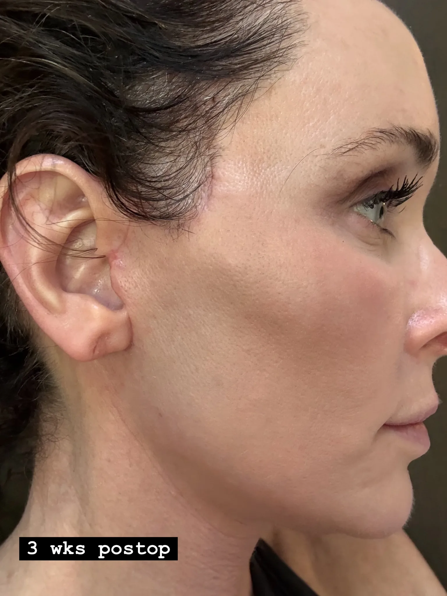 Profile view of a woman three weeks post-surgery