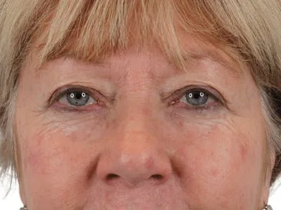 Close-up of a woman's face after blepharoplasty surgery.