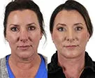 Before and after deep plane facelift comparison.