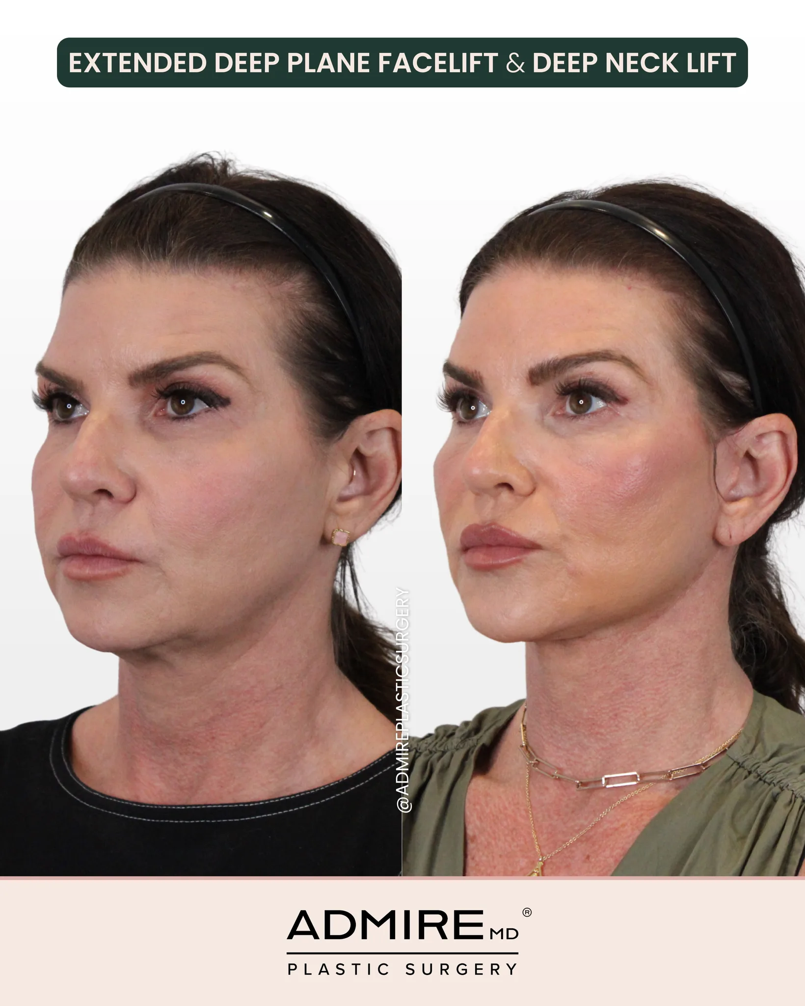 Before and after deep plane facelift and neck lift results.