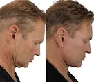 Profile comparison of a man's cosmetic procedure results.