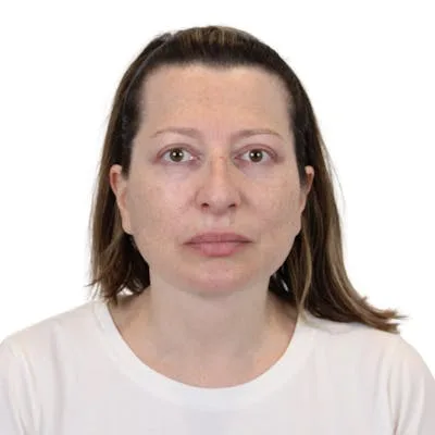 A woman after a deep plane facelift procedure.