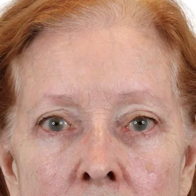 Close-up of a woman's face after blepharoplasty surgery.