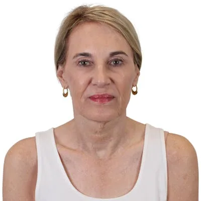 Portrait of a woman for deep plane facelift consultation.