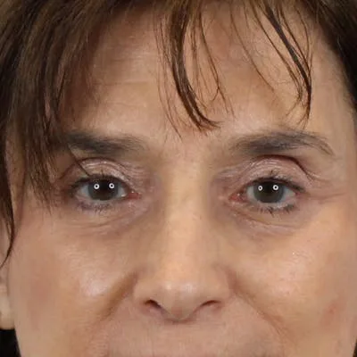 Close-up of a woman's eyes after blepharoplasty.