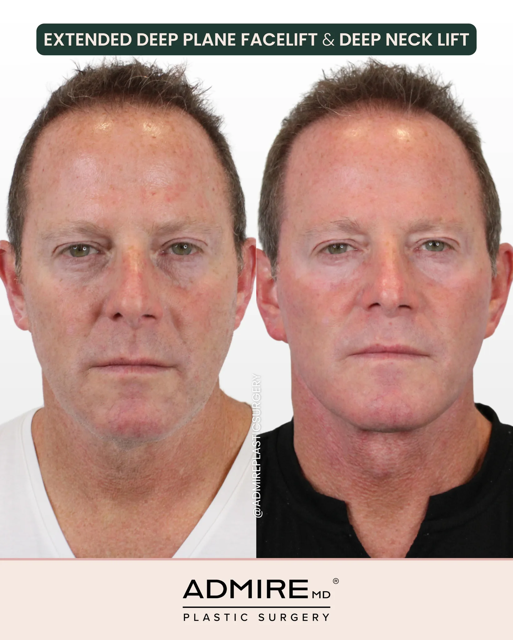 Before and after photos of a male facelift patient.