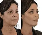 Before-and-after profile of a woman's cosmetic procedure.