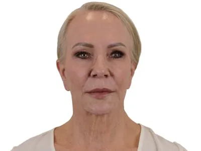 A woman posing for a lip lift consultation.