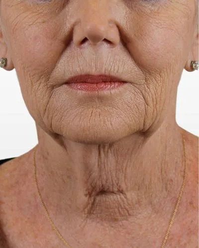 Close-up of a woman's lower face showing wrinkles and fine lines.