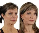 Before and after cosmetic treatment of a woman's face.