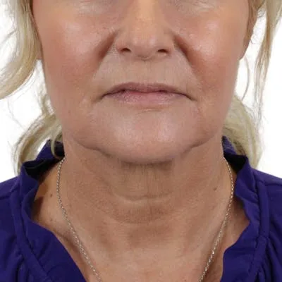 Close-up of a woman's face after a lip lift procedure.