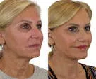 A woman's face before and after cosmetic treatment comparison.