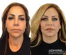 Before-and-after facelift surgery on a female patient.
