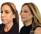 Before and after facelift side profile