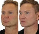 Before and after images of a male cosmetic procedure.