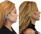 Before and after profile comparison of a facelift.