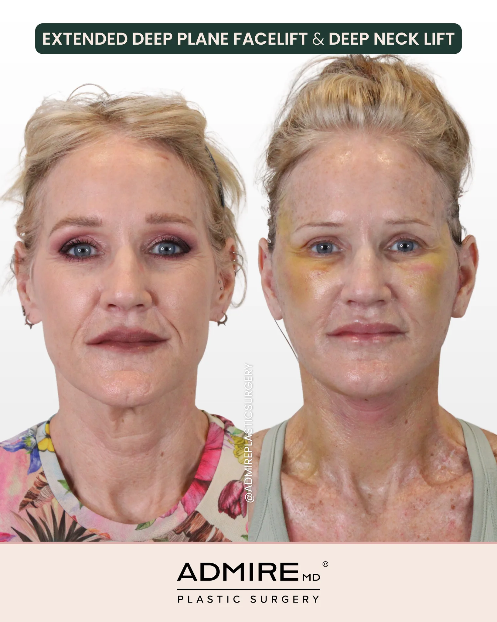 Before-and-after photo of a facelift and neck lift patient.