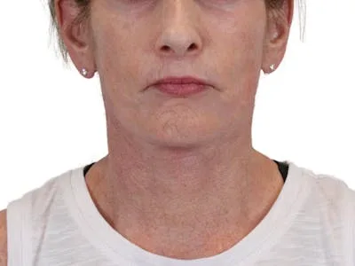 A woman after a lip lift procedure.
