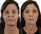 Before and after photo of a woman's cosmetic procedure.