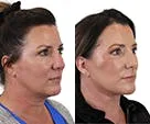 Before-and-after profile photos of a deep plane facelift.