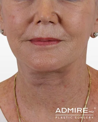 Close-up of a woman's lower face after a lip lift procedure.