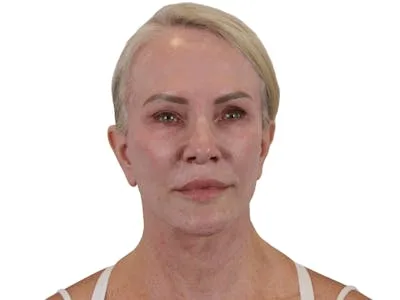 A woman after a lip lift procedure.