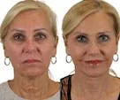 Before and after photos of a woman following cosmetic treatment.