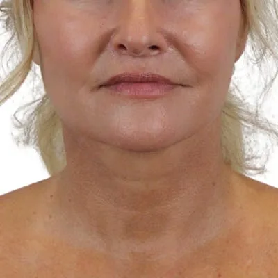 Close-up of a woman's face after a lip lift procedure.