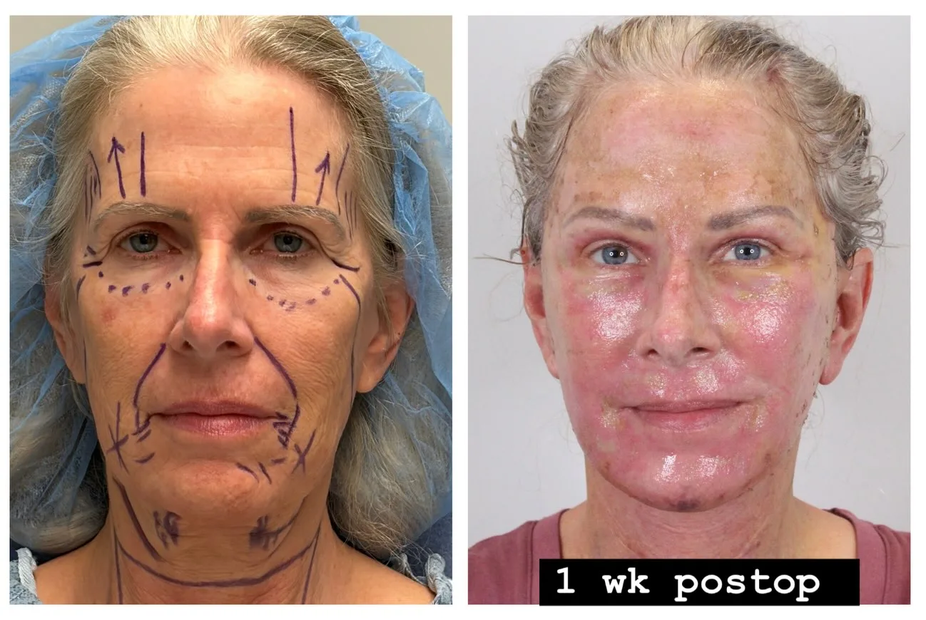 Before and after photo of a cosmetic surgery patient.