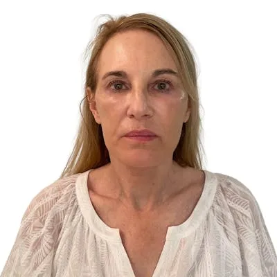 Woman after deep plane facelift procedure.