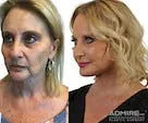Before and after facelift comparison of a woman.