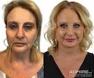 Before-and-after facelift transformation of a woman.