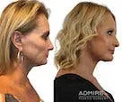 A side-by-side comparison of two facial profiles.