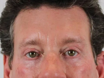 Close-up of a man's face after blepharoplasty surgery.