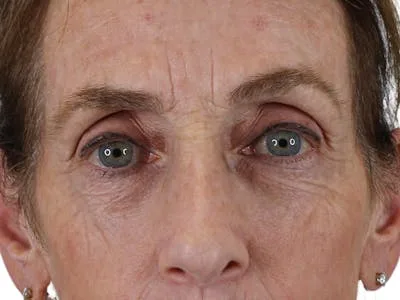 Close-up of a woman's eyes showing signs of aging.