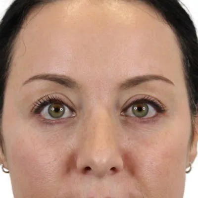 Close-up of a woman's eyes after blepharoplasty procedure.
