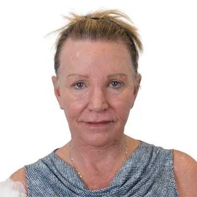 Woman after deep plane facelift procedure.